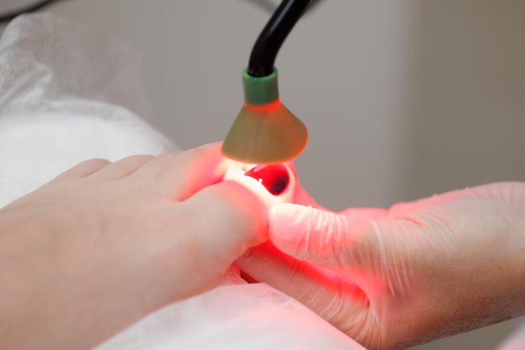 Как избавиться от грибка на ногте: эффективность лечения грибка ногтей лазером